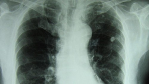 Tuberculose : le taux de succès thérapeutique estimé à 59 %